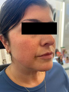 Fillers Before & After Image