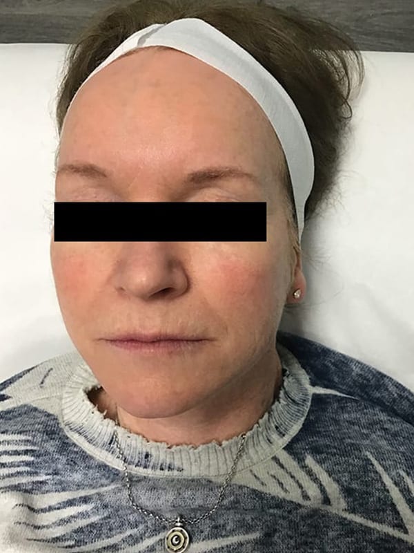 Sciton MOXI Before and After | Dedham Medical Aesthetics