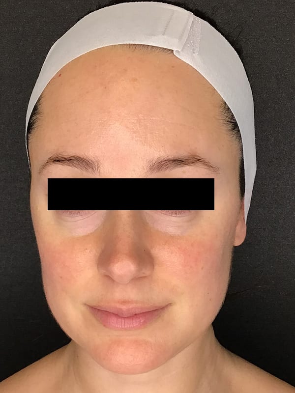 Sciton MOXI Before and After | Dedham Medical Aesthetics