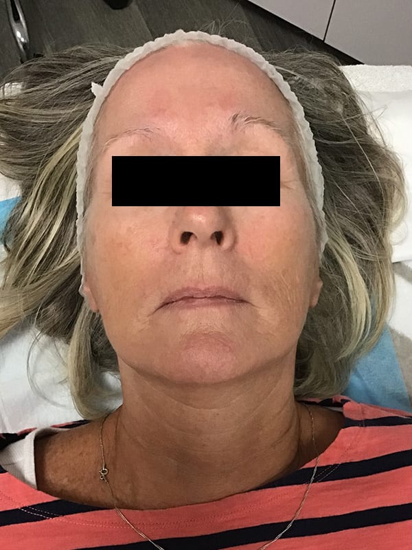 Chemical Peels Before & After Image