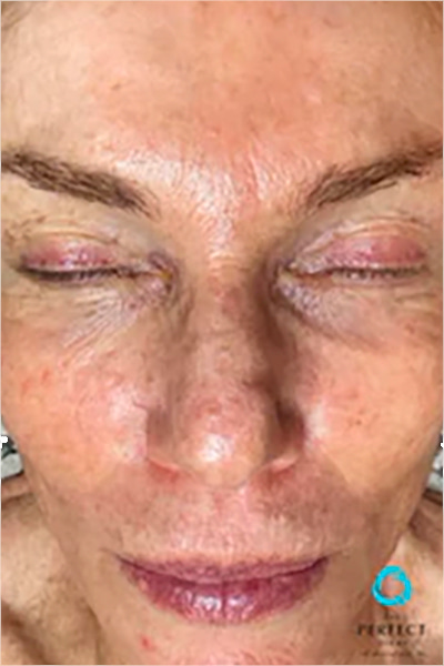 The Perfect Derma Peel Before & After Image