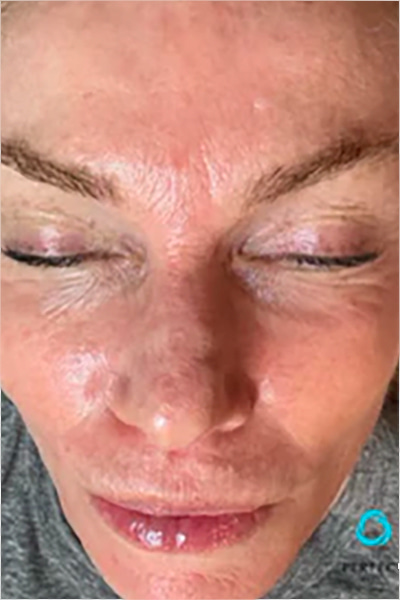 The Perfect Derma Peel Before & After Image