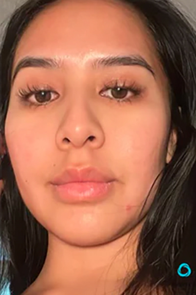 The Perfect Derma Peel Before & After Image