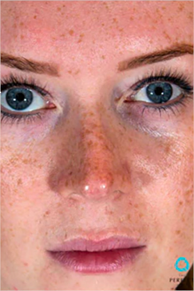 The Perfect Derma Peel Before & After Image