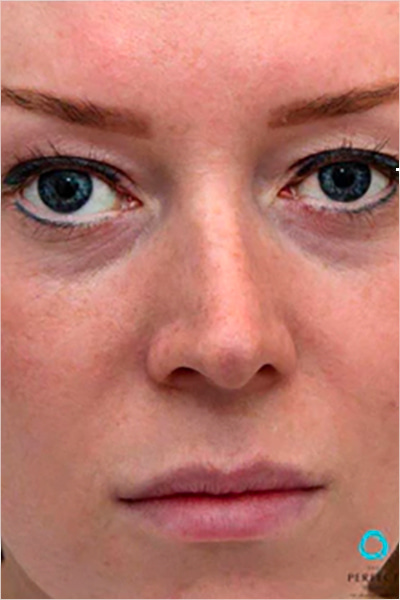 The Perfect Derma Peel Before & After Image