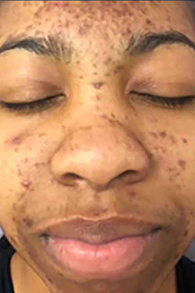 The Perfect Derma Peel Before & After Image