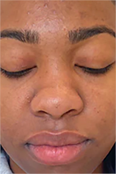 The Perfect Derma Peel Before & After Image