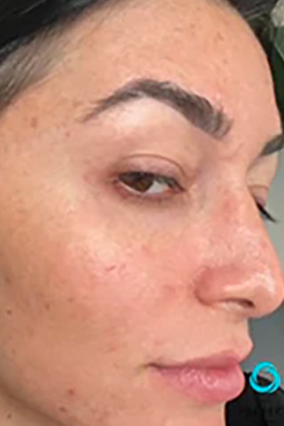 The Perfect Derma Peel Before & After Image