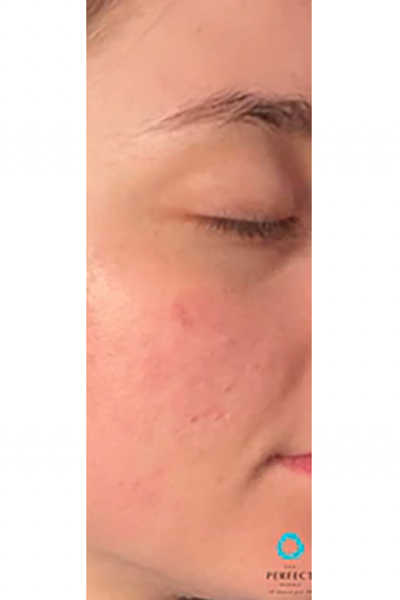 The Perfect Derma Peel Before & After Image