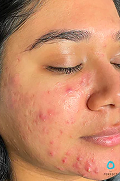 The Perfect Derma Peel Before & After Image