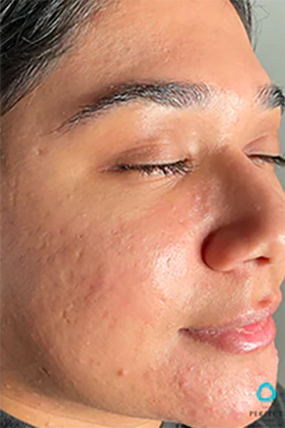 The Perfect Derma Peel Before & After Image