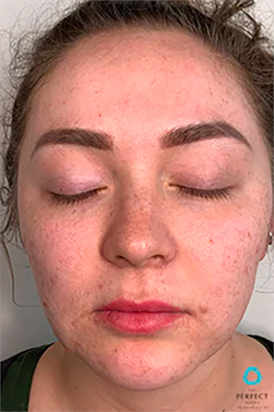 The Perfect Derma Peel Before & After Image