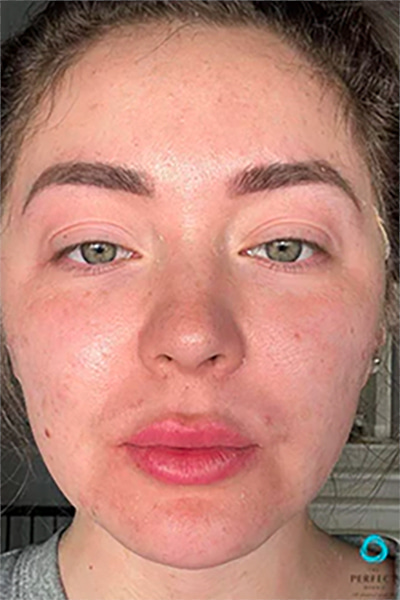 The Perfect Derma Peel Before & After Image